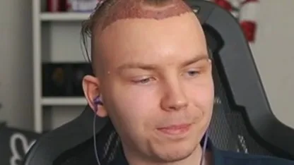 😀 Оказывается, что Строго перенёс операцию по пересадке волос Результаты на фото…