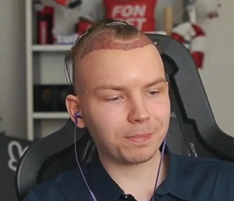 😀 Оказывается, что Строго перенёс операцию по пересадке волос Результаты на фото…